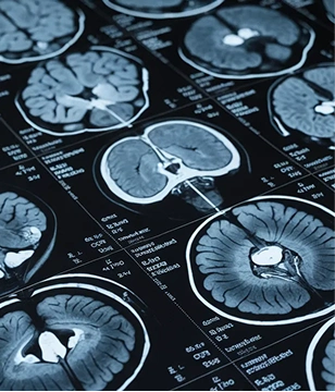 Traumatic Brain Injury Cases We Handle in Long Beach